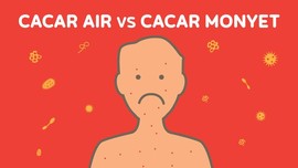 INFOGRAFIS: Cacar Monyet Vs Cacar Air
