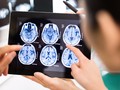 7 Penyebab Tumor Otak yang Harus Diwaspadai