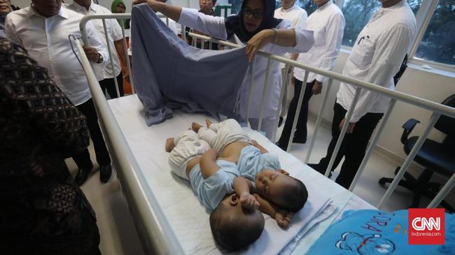 Bayi Kembar Siam Tapanuli Jalani Operasi Pemisahan 23 Juli
