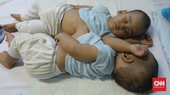 Tim Medis: Hati Bayi Kembar Adam dan Malik Menyatu