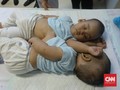 Tim Medis: Hati Bayi Kembar Adam dan Malik Menyatu