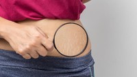 Stretch Mark Merah dan Putih Susah Pudar? Ini Kandungan yang Perlu Kamu Tahu