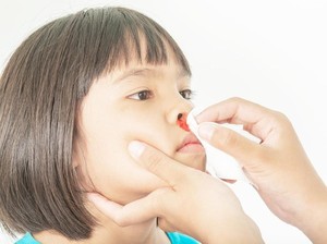 Anak Sering Mimisan? Kenali Penyebab, Ciri, dan Pengobatan yang Tepat