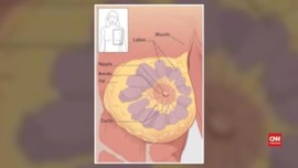 VIDEO: Kenali Kanker Payudara yang Umum Menyerang Wanita