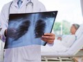China Yakin Pneumonia Misterius Disebabkan Virus Baru
