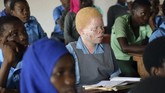 Asosiasi Nasional Orang dengan Albinisme mencatat sejak 2014, sekitar 26 orang albino tewas dan 11 lainnya hilang. (AP Photo/Thoko Chikondi)