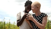 Warga albino di Malawi hidup di bawah bayang-bayang kemiskinan, hingga ancaman penculikan dan pembunuhan. (AP Photo/Thoko Chikondi)