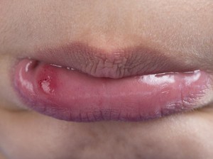 Benarkah Kurang Vitamin C Bikin Sering Sariawan? Dokter Ungkap Faktanya