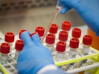 Epidemiolog: Long Covid Representasi Kegagalan Negara