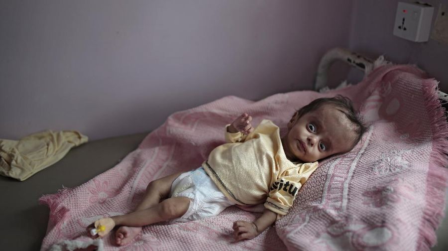 A woman holds her malnourished boy at a feeding center at Al-Sabeen hospital in Sanaa, Yemen, Saturday, June 27, 2020. (AP Photo/Hani Mohammed)