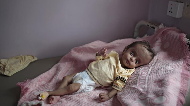 A woman holds her malnourished boy at a feeding center at Al-Sabeen hospital in Sanaa, Yemen, Saturday, June 27, 2020. (AP Photo/Hani Mohammed)