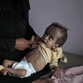Negara Ini Umumkan Keadaan Darurat, Anak-anak Kurang Gizi!