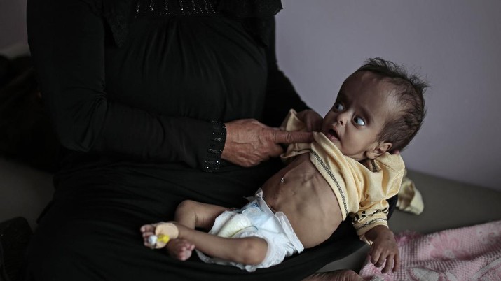 Bayi Kurang Gizi di Yaman A woman holds her malnourished boy at a feeding center at Al-Sabeen hospital in Sanaa, Yemen, Saturday, June 27, 2020. (AP Photo/Hani Mohammed)