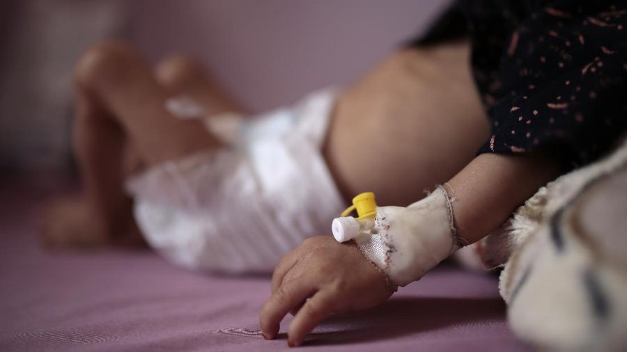 A woman holds her malnourished boy at a feeding center at Al-Sabeen hospital in Sanaa, Yemen, Saturday, June 27, 2020. (AP Photo/Hani Mohammed)