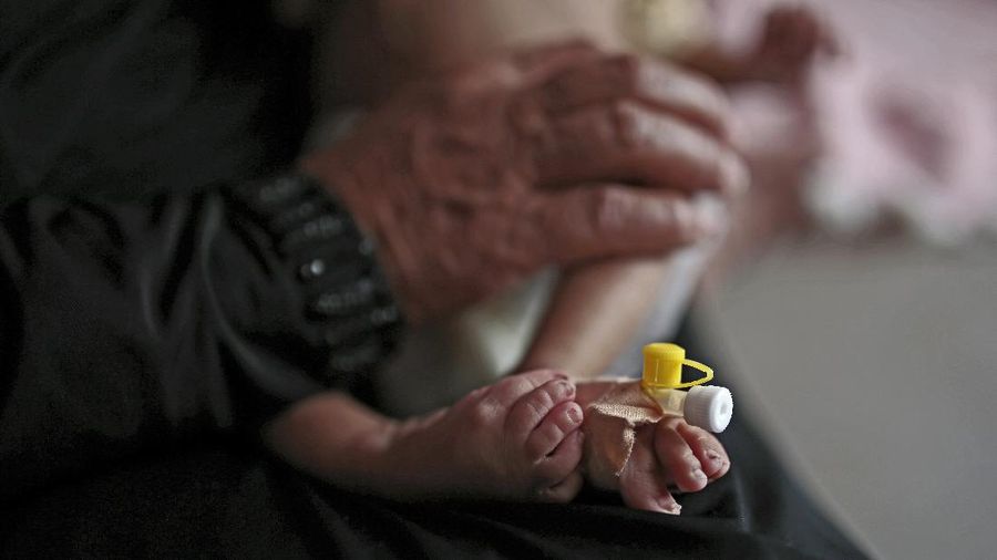 A woman holds her malnourished boy at a feeding center at Al-Sabeen hospital in Sanaa, Yemen, Saturday, June 27, 2020. (AP Photo/Hani Mohammed)