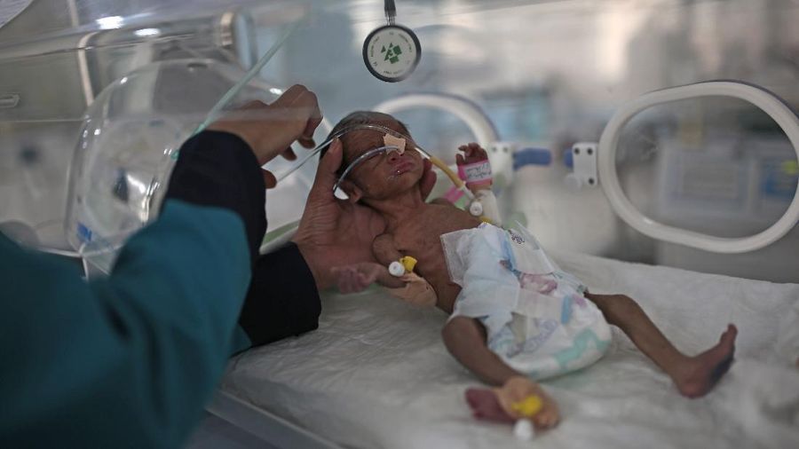 A woman holds her malnourished boy at a feeding center at Al-Sabeen hospital in Sanaa, Yemen, Saturday, June 27, 2020. (AP Photo/Hani Mohammed)