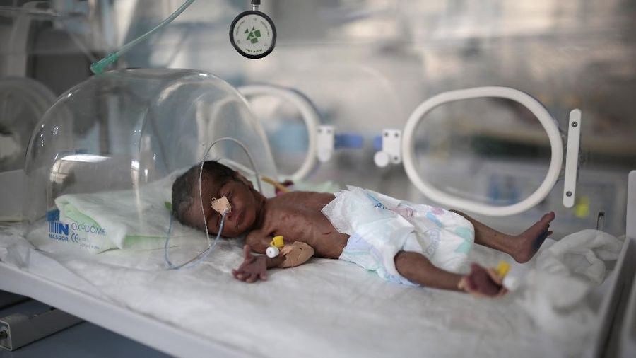 A woman holds her malnourished boy at a feeding center at Al-Sabeen hospital in Sanaa, Yemen, Saturday, June 27, 2020. (AP Photo/Hani Mohammed)