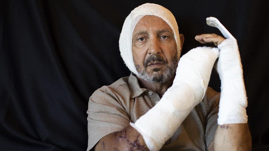Potret goresan luka korban ledakan Libanon. (AP/Hassan Ammar)