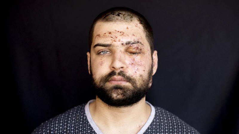 Potret goresan luka korban ledakan Libanon. (AP/Hassan Ammar)