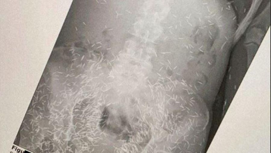 Penampakan Ratusan Susuk di Tubuh Wanita Berusia 55 Tahun (Foto: Instagram/tasyabira)