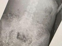 Fenomena Susuk, Tak Kasat Mata tapi Kelihatan Lewat Xray Lho
