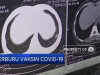 WHO: Tidak Semua Orang Akan Punya  Akses Ke Vaksin Covid-19