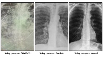 Gambar Xray Paru Paru Normal ~ C Foto Gambar