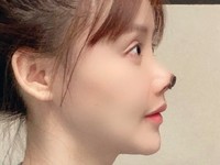 Ya Ampun Kesian! Hidung Artis China Ini Membusuk Usai Operasi