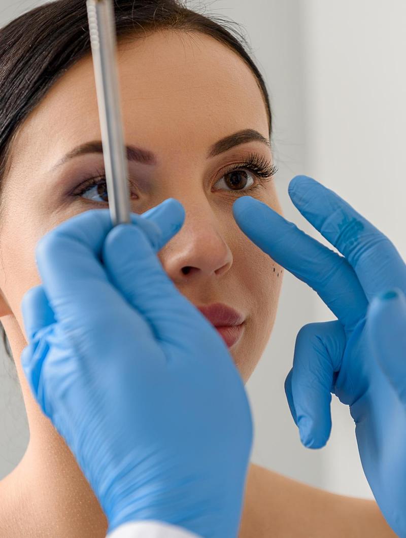 Mengenal Rhinoplasty Tulang Iga: Operasi Plastik Hidung Agar Proporsional
