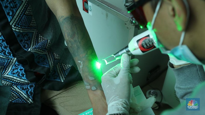 Peserta menjalani penghapusan tato dengan mesin laser di Masjid Baitul Muhyi, Jakarta, Jumat (30/4/2021). Dalam rangka bulan suci Ramadhan, IMS bekerjasama dengandengan Baznas (Bazis) DKI Jakarta menggelar layanan hapus tato gratis. Adapun peraturan yang harus diikuti pesertapeserta yakni dengan melakukan tes kesehatan serta tes Covid-19 menggunakan genose. Fadil (25) salah satu peserta hapus tato menjelaskan 