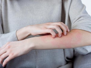 Jangan Biarkan Alergi Hentikan Aktivitasmu, Ini Cara Efektif Atasinya