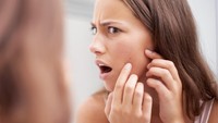 Bekas Jerawat Nggak Hilang-hilang? Cek Cara Pilih Serum Dark Spot Sesuai 