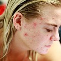 Cara Ampuh Mengatasi Jerawat di Dagu Versi Dermatolog