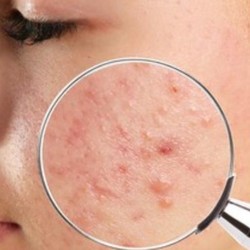 20 Cara Menghilangkan Bruntusan Wajah Secara Alami dan Aman
