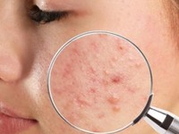 20 Cara Menghilangkan Bruntusan Wajah Secara Alami dan Aman
