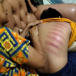 Tradisi Turun Temurun, Ini Asal Usul Kerokan