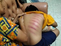 Tradisi Turun Temurun, Ini Asal Usul Kerokan