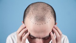 Mengenal Proses Transplantasi Rambut yang Lagi Ngetren