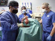Pasien Pertama Cangkok Jantung Babi Meninggal Setelah 2 Bulan