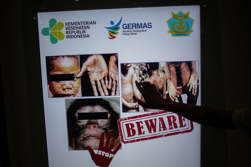 Telapak tangan pasien kasus cacar monyet dari Lodja, sebuah kota yang terletak di dalam Zona Kesehatan Katako-Kombe, terlihat selama penyelidikan kesehatan di Republik Demokratik Kongo pada tahun 1997. (via REUTERS/CDC)