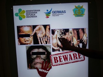 Cacar Monyet Tembus 100 Kasus, WHO Gelar Pertemuan Darurat