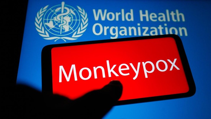 Ilustrasi cacar monyet (LightRocket via Gett/SOPA Images)