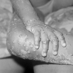 Ini Tanda-Tanda Seseorang Sudah Tertular Virus Mpox