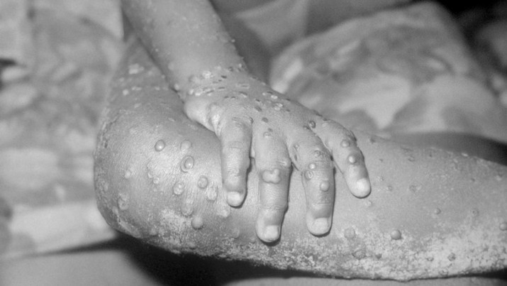 Monkeypox, Anggota Keluarga Orthopox Virus, adalah infeksi yang secara tidak sengaja menular ke manusia karena kemiripannya dengan virus cacar. (Universal Images Group via Getty/BSIP)