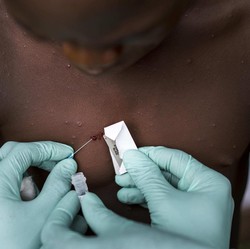 Kemenkes Ungkap Provinsi dengan Kasus Mpox Terbanyak di RI