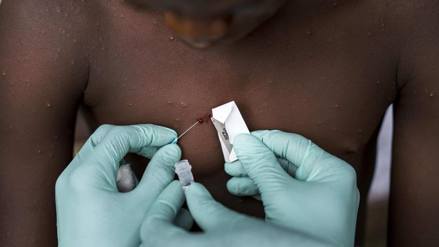 Pusat Pengendalian Penyakit meneliti virus MonkeyPox di lapangan. (via Getty Im/The Washington Post)