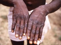 Virus Cacar Monyet Mpox: Ini Gejala & Sejarah Penyebaran di RI