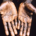 Daftar 10 Kelompok yang Rentan Tertular Mpox, Anda Termasuk?
