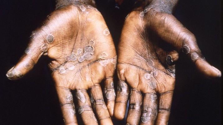 Telapak tangan pasien kasus cacar monyet dari Lodja, sebuah kota yang terletak di dalam Zona Kesehatan Katako-Kombe, terlihat selama penyelidikan kesehatan di Republik Demokratik Kongo pada tahun 1997. (via REUTERS/CDC)