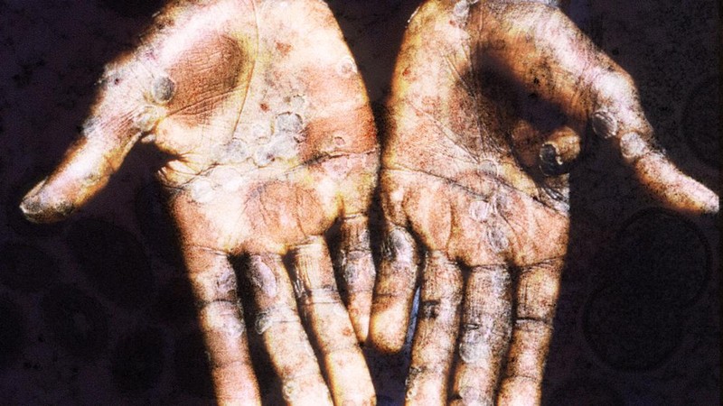 Monkeypox si Cacar Monyet yang Mulai Meresahkan